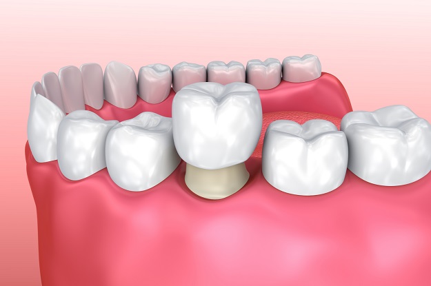 What Are The Advantages Of Visiting A Saturday Dentist Near Me For Dental Crowns In Houston?”