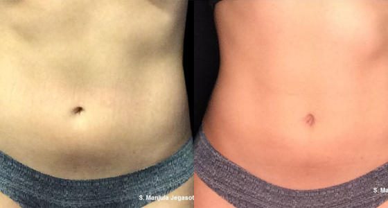 kybella injection for belly fat