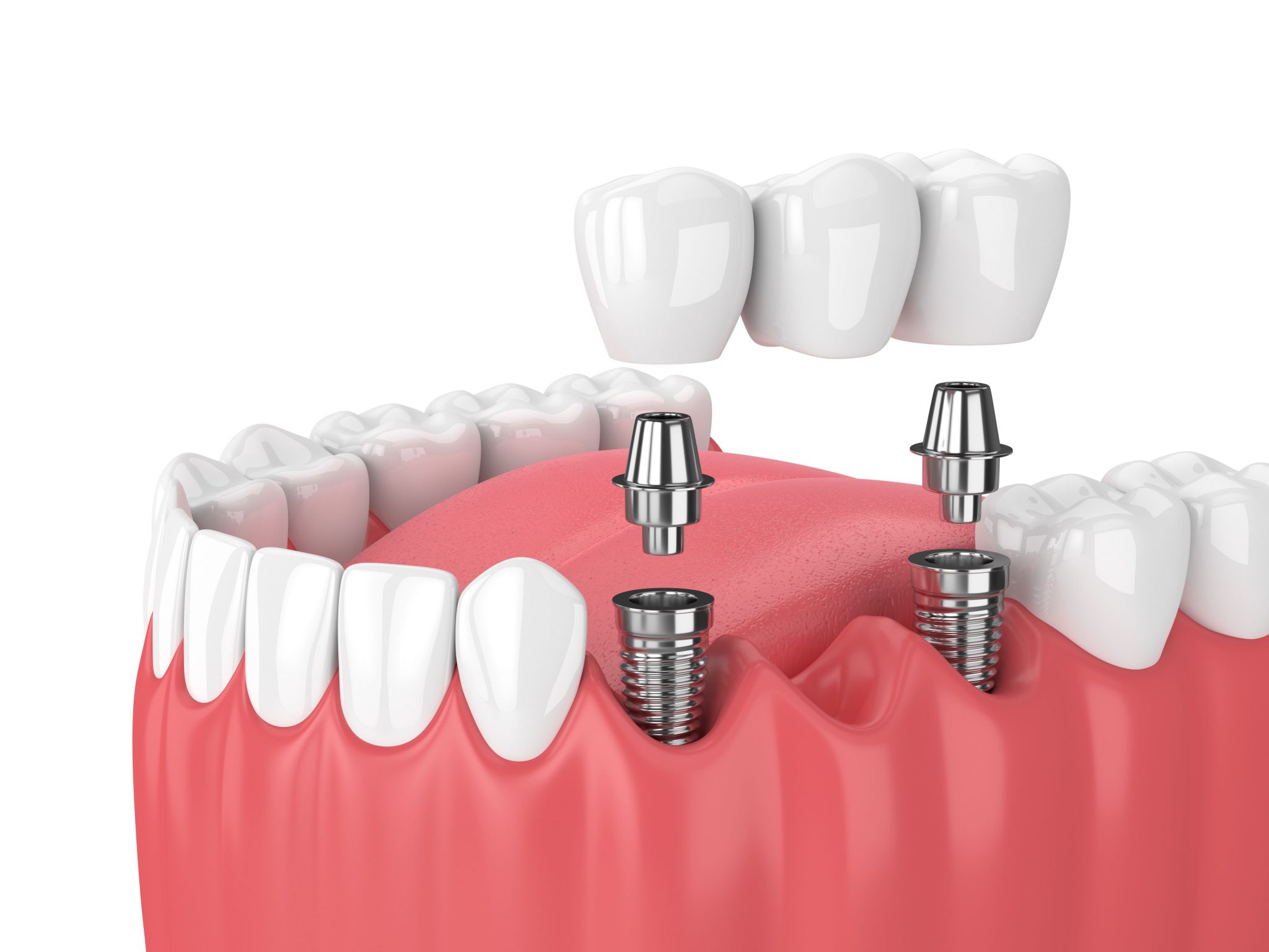 What Are the Advantages of Choosing a Dental Implant Dentist in Houston, TX?