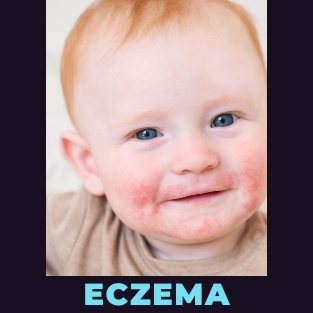 types of eczema