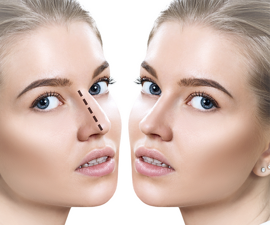 Picking the Best Rhinoplasty Surgeon In Dubai With Confidence