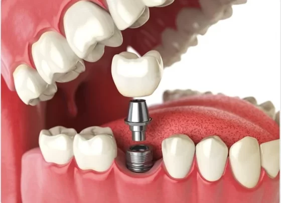 Dental Implants in the UK