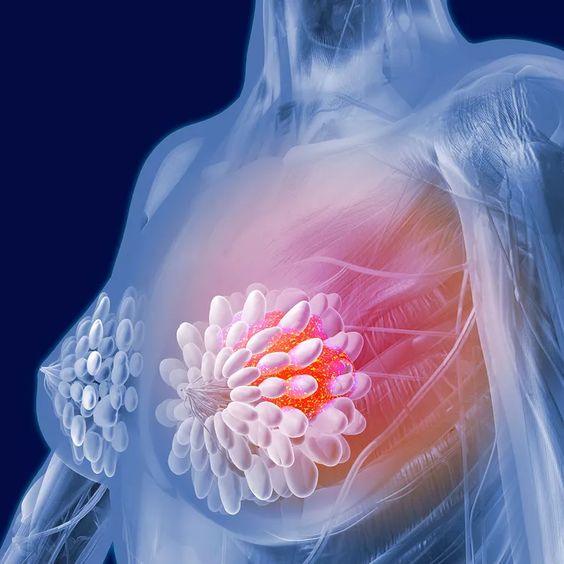 Navigating Breast Cancer Treatment: From Innovations to Affordability