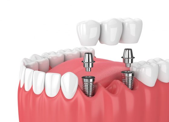 Dental Implant Procedure