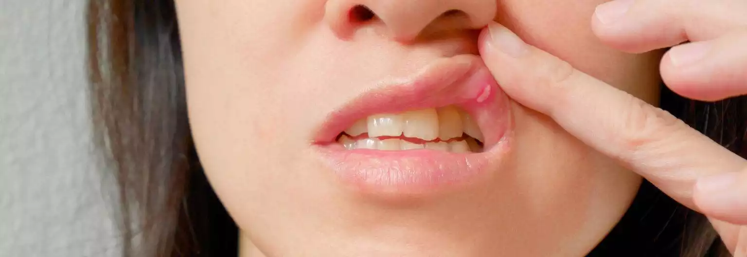 How Effective Is Alum For Canker Sores? A Comprehensive Guide