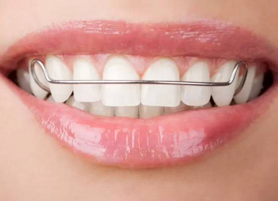 dental braces singapore