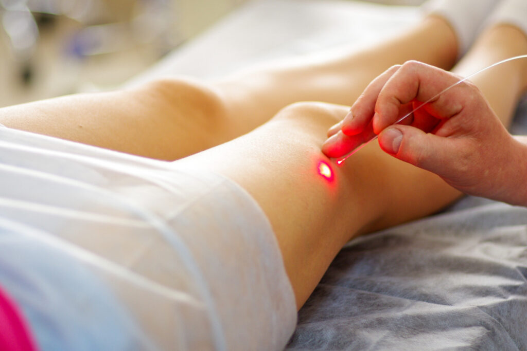 varicose veins laser therapy