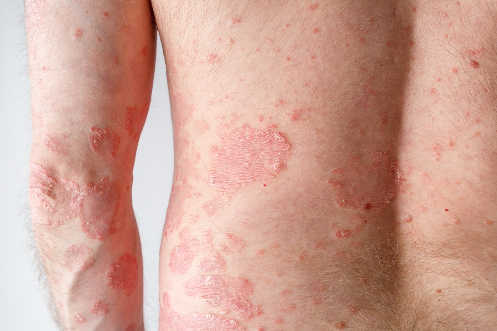 Psoriasis is a chronic condition