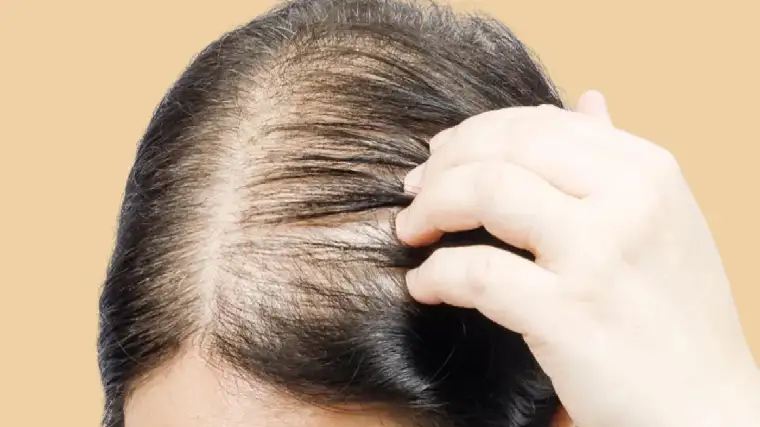 Hair Loss Treatments