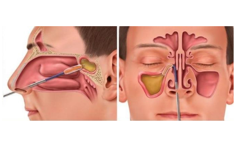 Chronic Sinusitis