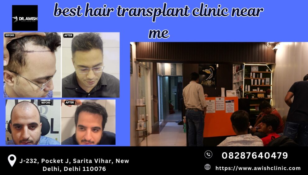 best hair transplant clinic near me