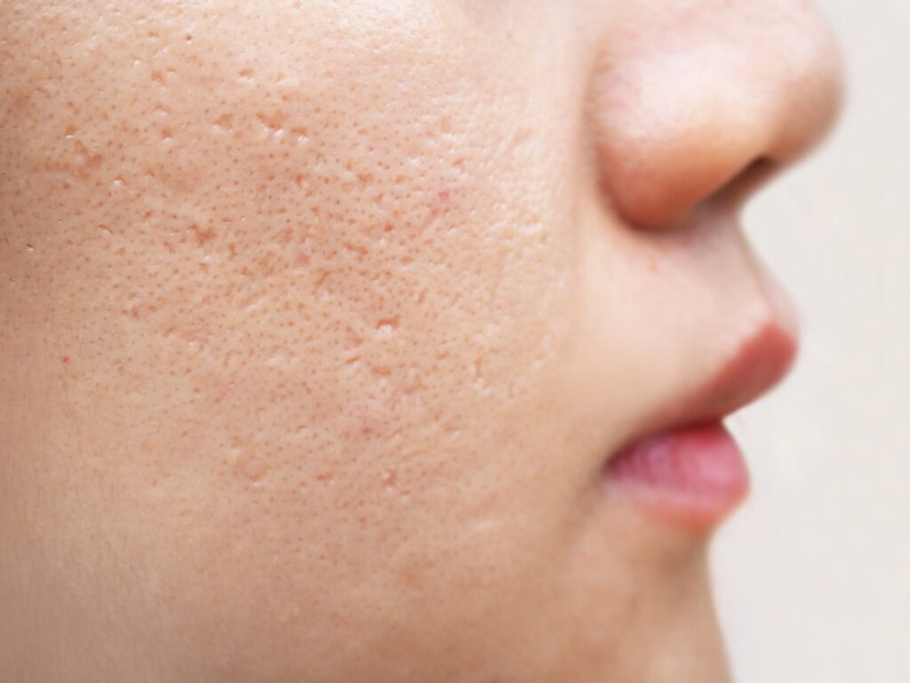Acne Scar Treatment in Dubai