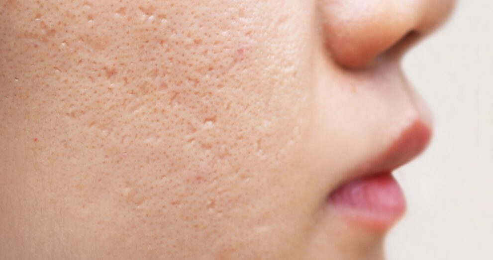 Acne Scar Treatment in Dubai