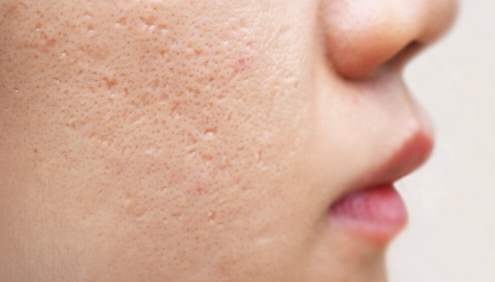 Acne Scar Treatment in Dubai