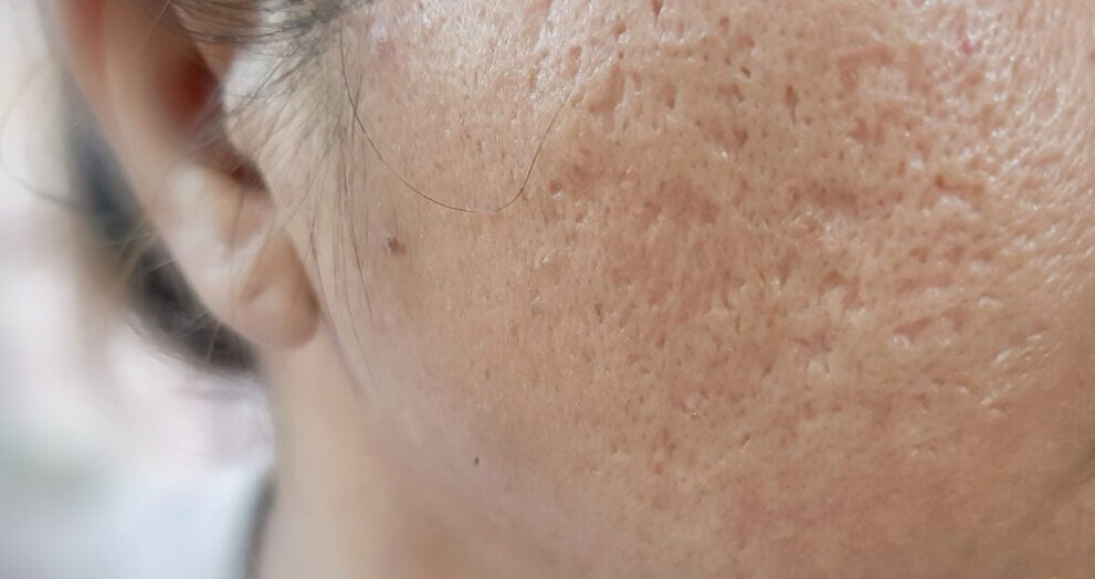 Acne Scar Treatment in Dubai
