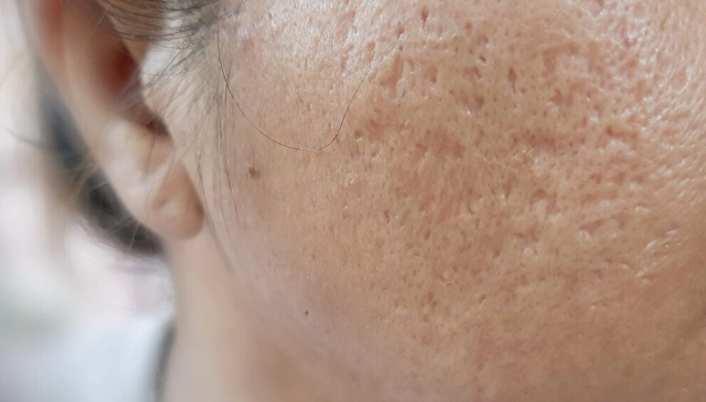 Acne Scar Treatment in Dubai