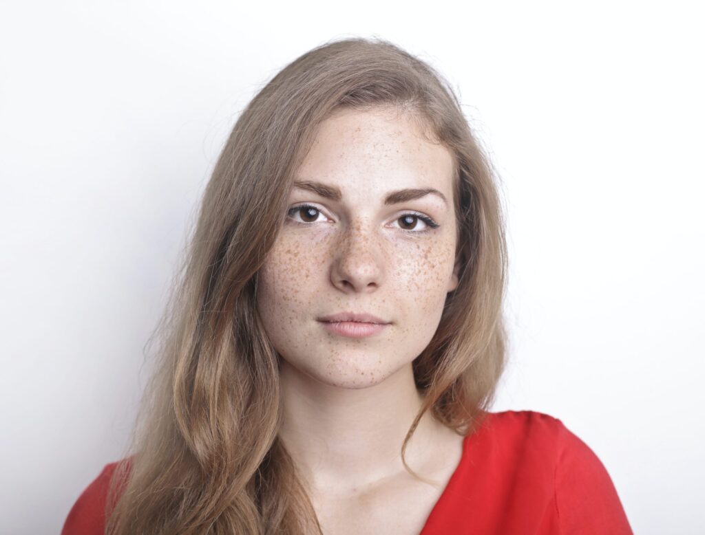 Freckles and Blemishes Treatment in Dubai