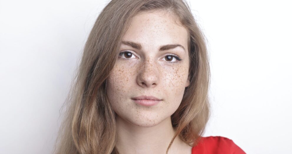 Freckles and Blemishes Treatment in Dubai