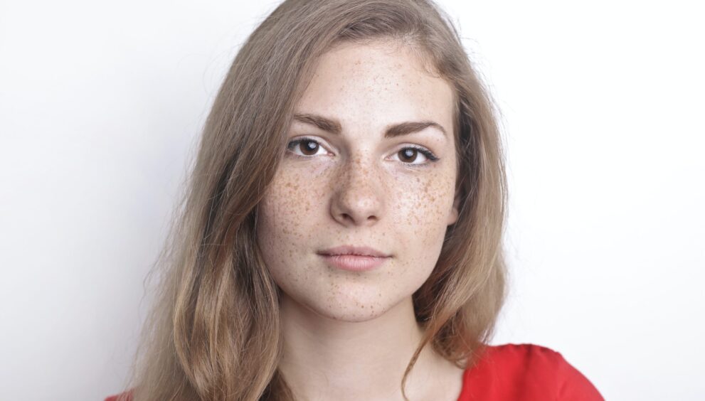 Freckles and Blemishes Treatment in Dubai