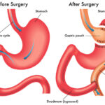Laparoscopic Anti-Reflux Surgery for GERD in Pakistan