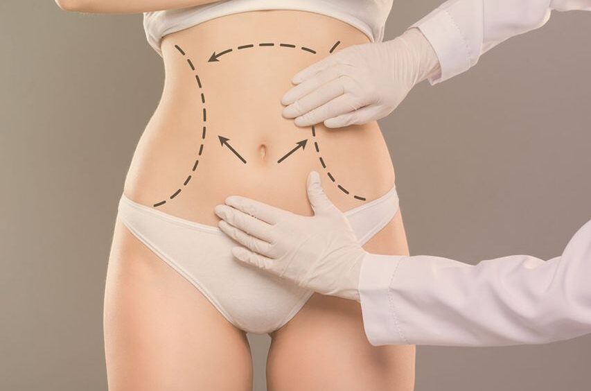 Recovery After Tummy Tuck