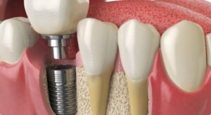 dental-implant