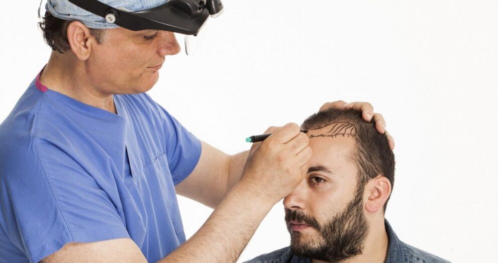 Hair Transplant in Dubai