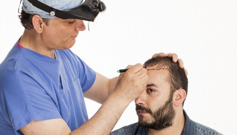 Hair Transplant in Dubai