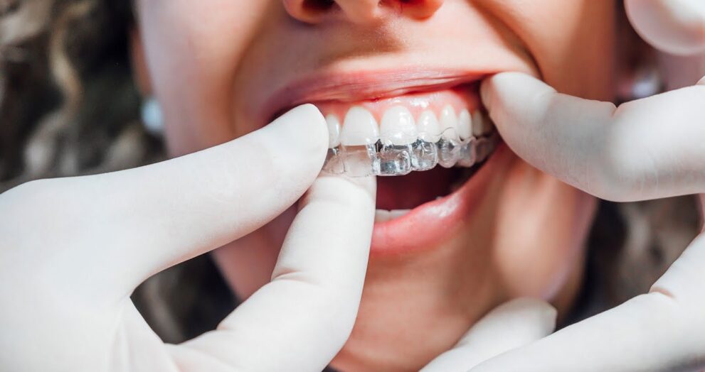 aligners