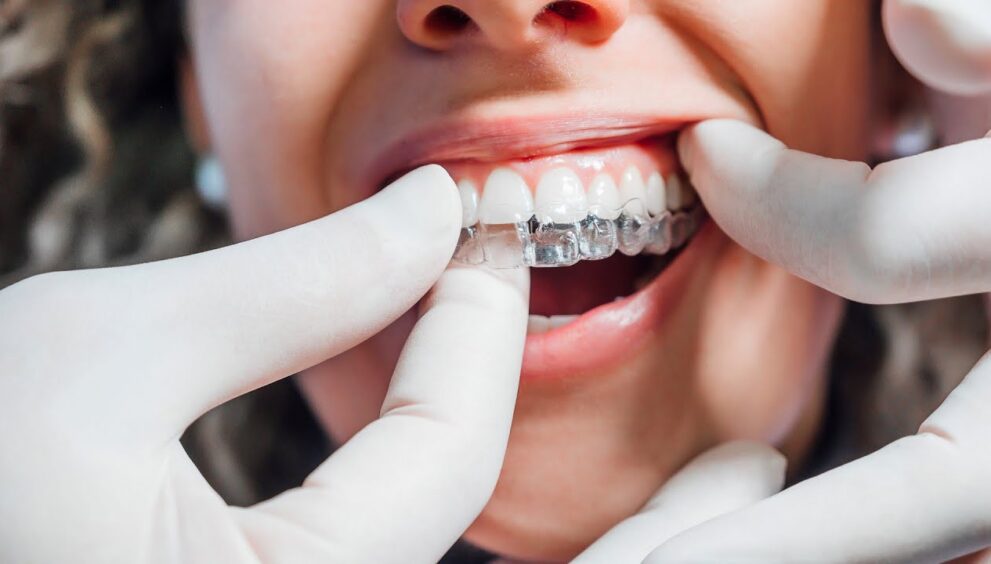 aligners