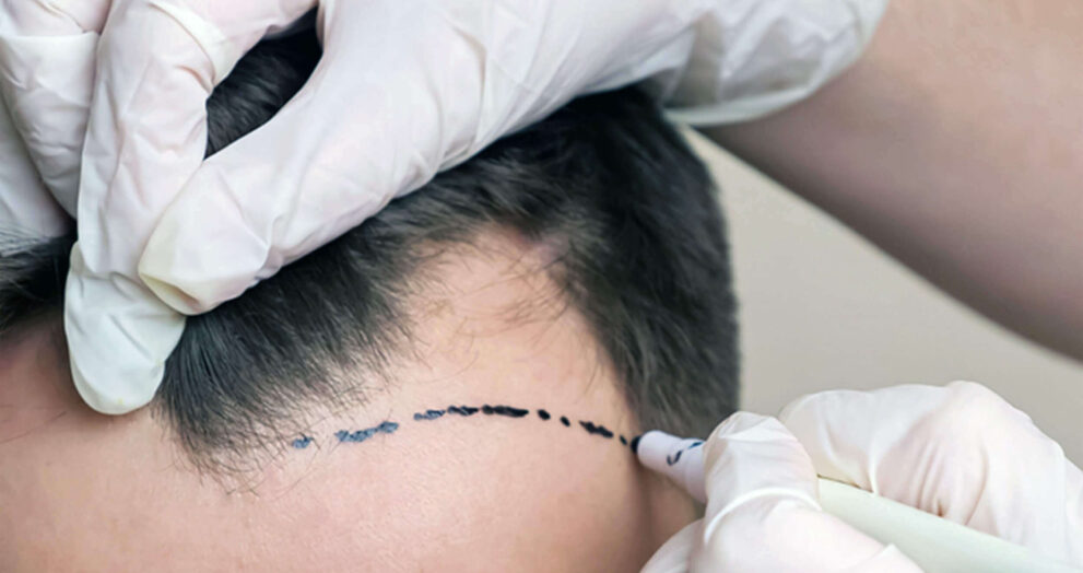 non surgical hair replacement in Dubai