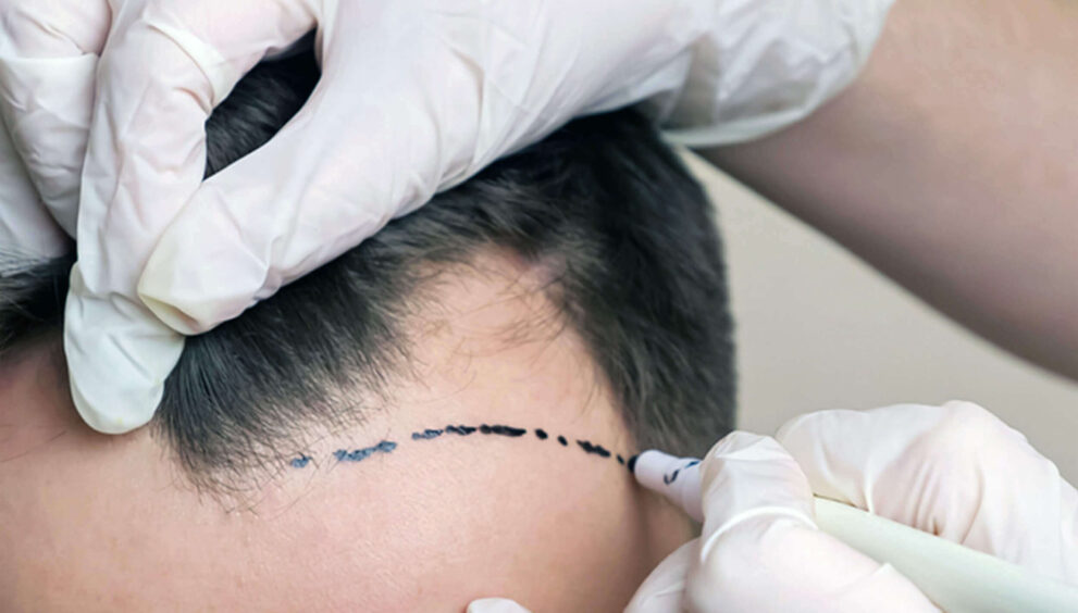 non surgical hair replacement in Dubai
