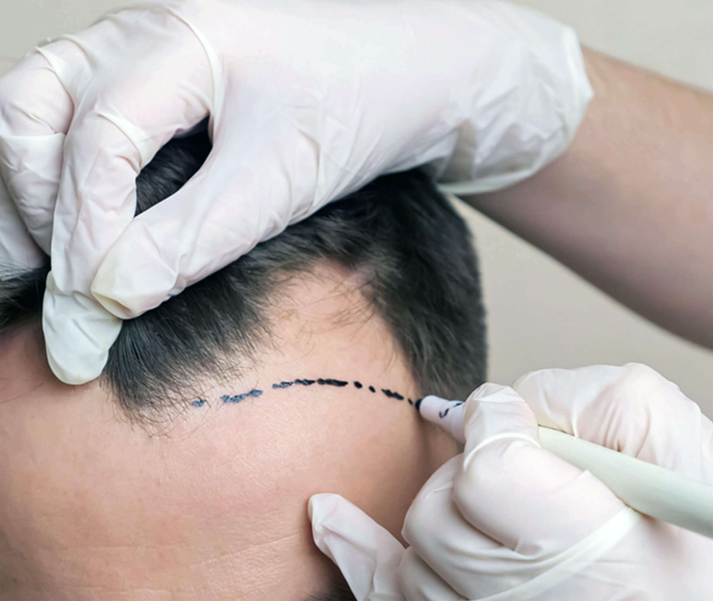 non surgical hair replacement in Dubai
