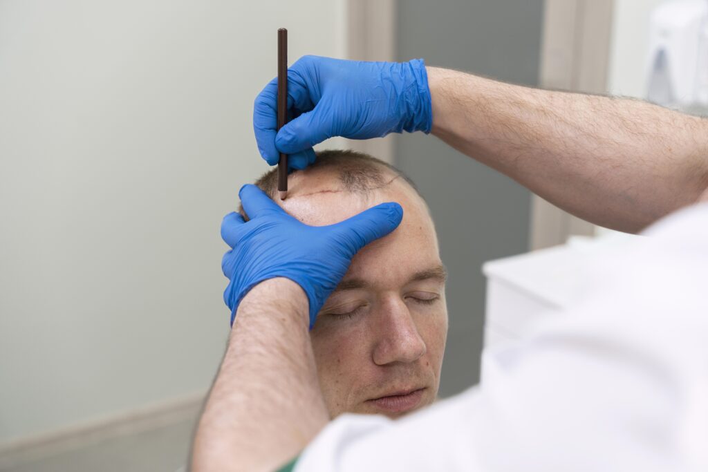 Non Surgical Hair Replacement in Dubai