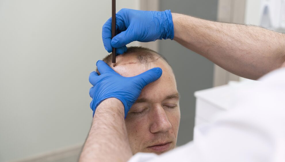 Non Surgical Hair Replacement in Dubai
