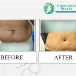 Does Cheek Filler Injections Really Reverse Aging Signs?