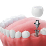 How to Manage Minor Orthodontic Issues at Home