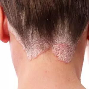 psoriasis treatment