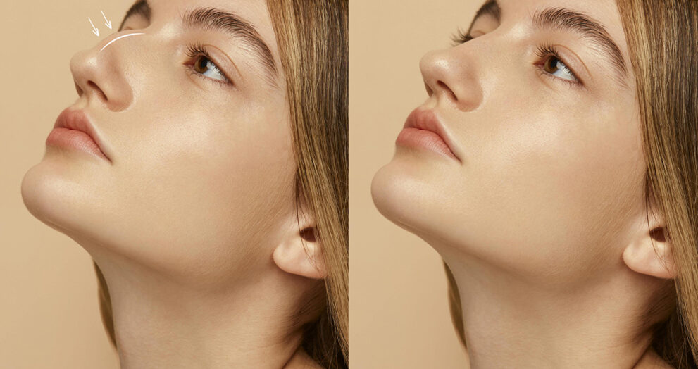 Rhinoplasty in Islamabad