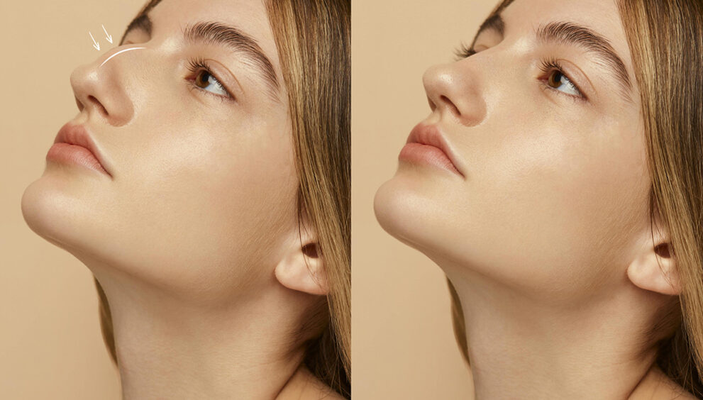 Rhinoplasty in Islamabad