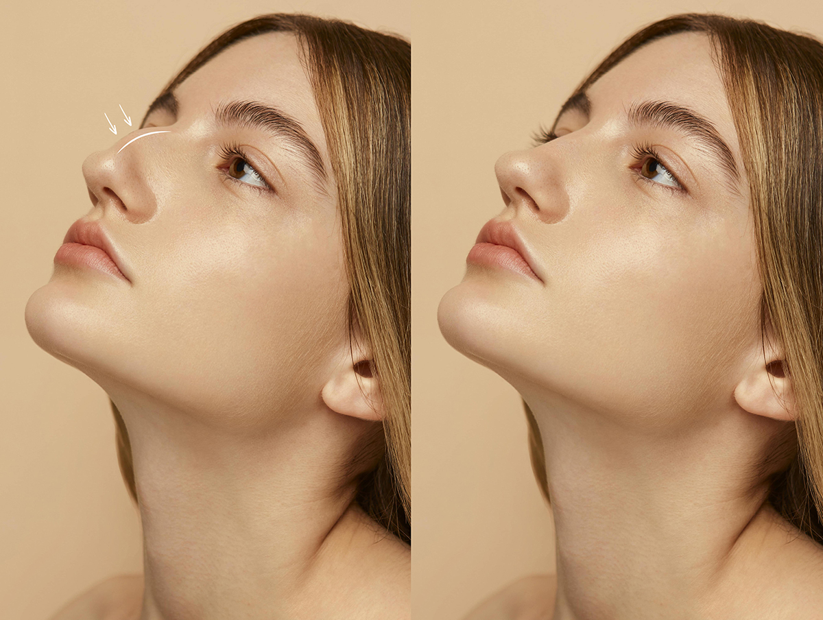 Rhinoplasty in Islamabad