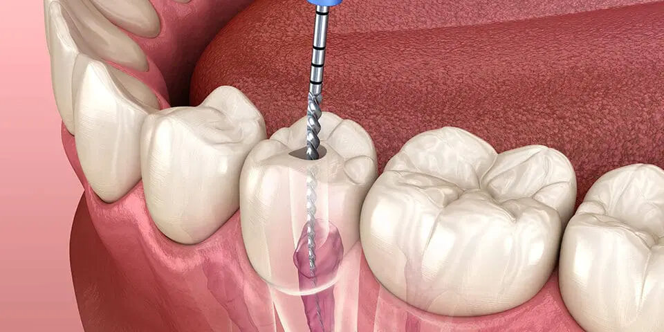 Advanced Root Canal Treatments in Dubai