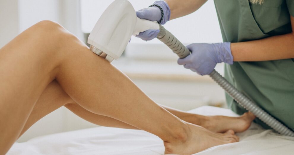 laser hair removal